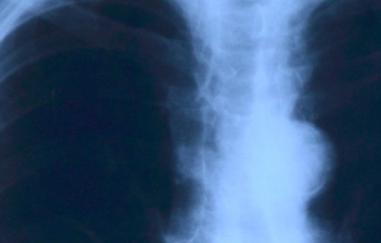 肺脓肿的早期症状有哪些_拓诊卫生资讯