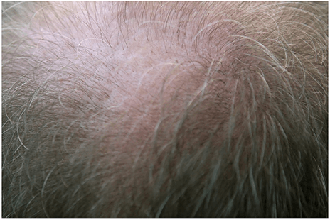 如何预防治疗马拉色菌毛囊炎