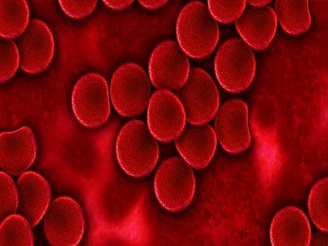 缺铁性贫血需警惕：长期缺铁可能诱发胃癌