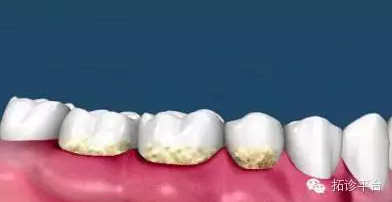 洗牙全过程，让你知道洗牙到底有没有必要
